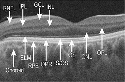 Thinning of Macular Neuroretinal Layers Contributes to <mark class="highlighted">Sleep Disorder</mark> in Patients With Type 2 Diabetes Without Clinical Evidences of Neuropathy and Retinopathy